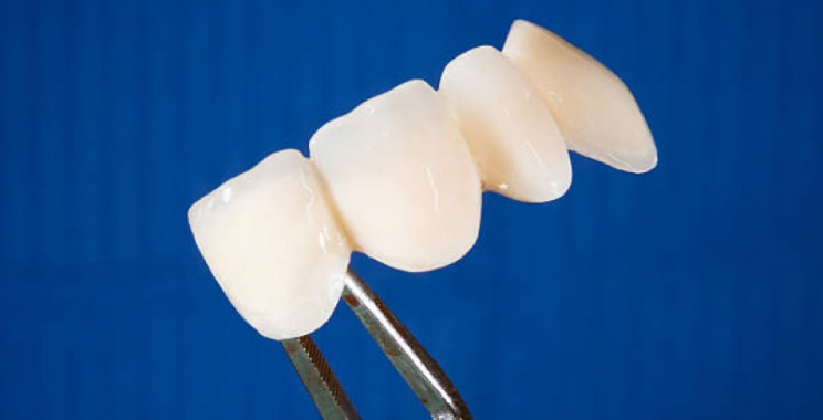 Partial Dentures Brisbane: Comfortable, Custom-fit Solutions