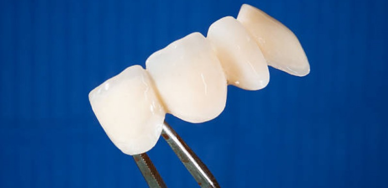 Partial Dentures Brisbane: Comfortable, Custom-fit Solutions