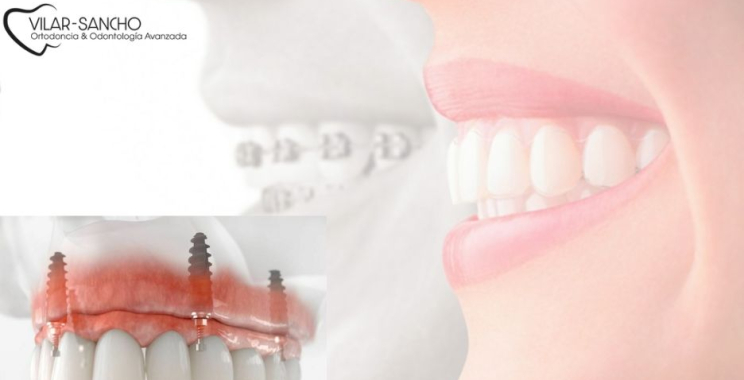 Sonrisa perfecta con ortodoncia discreta en Pozuelo de Alarcón