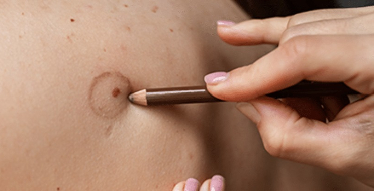 Dubai scar camouflage for refined, natural-looking results