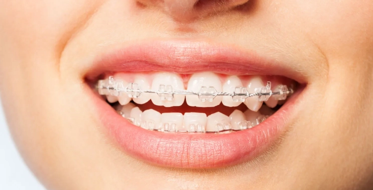 Clear Path to Your Smile: Custom Invisalign Cost Insights