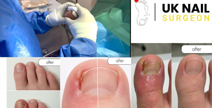 Urgent nail care: expert treatment for toenail problems